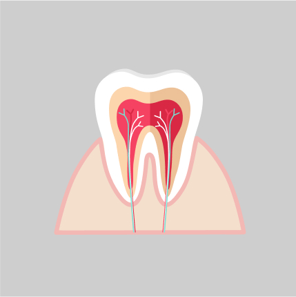 Root Canal Therapy Graphic