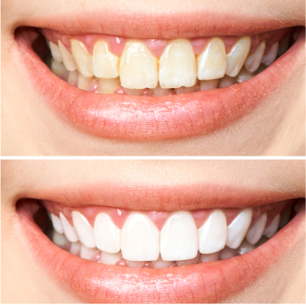before & After KöR® Teeth Whitening in Coral Gables, FL