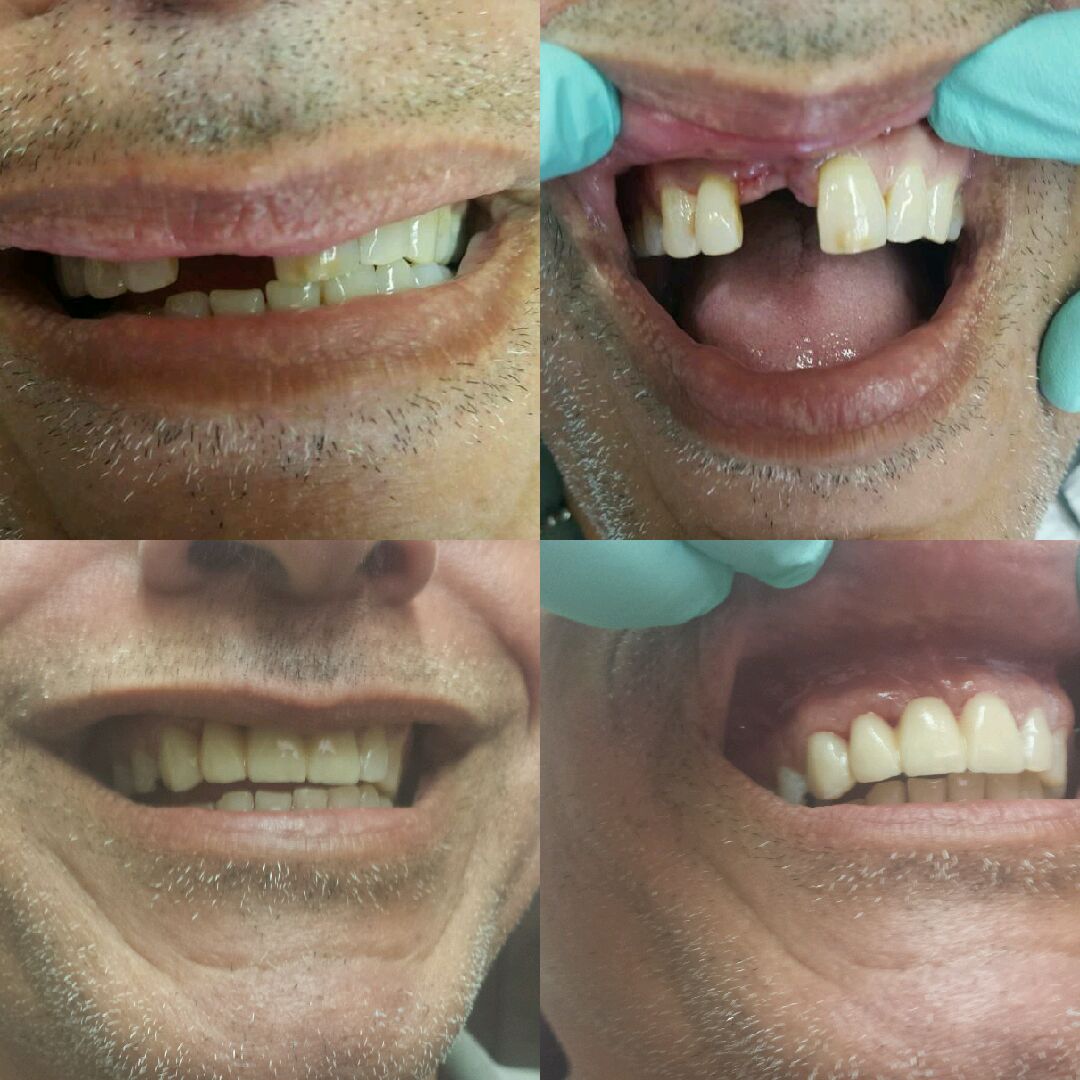 Smile Makeover