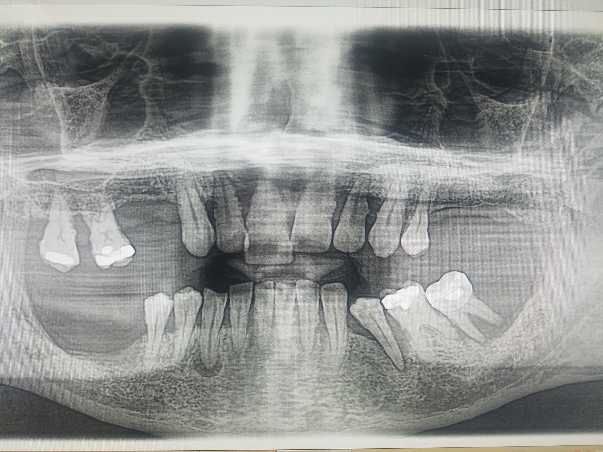 Smile Makeover