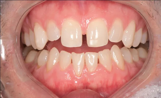 Before Clear Aligner Treatment