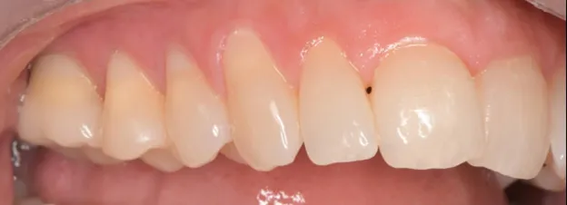 Tooth after custom dental crown placement