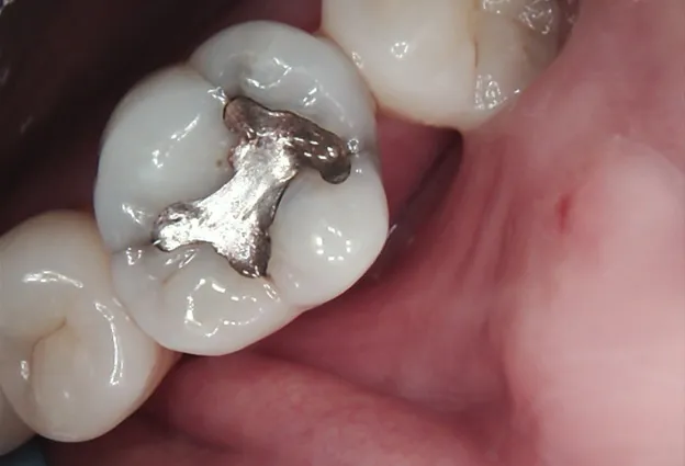 Tooth before custom dental crown placement