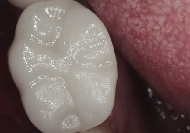 Tooth after dental crown treatment at Minorca Smiles