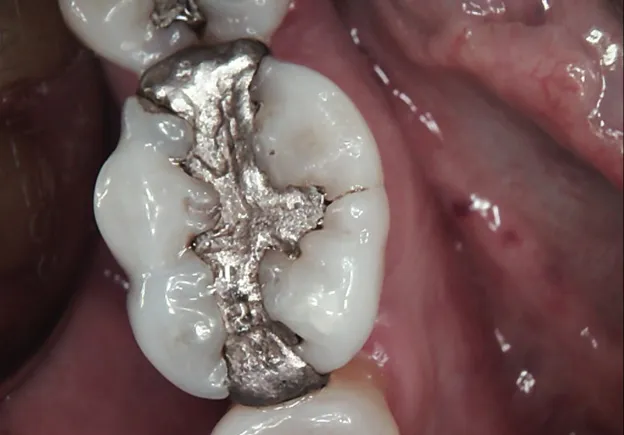 Tooth before dental crown treatment at Minorca Smiles
