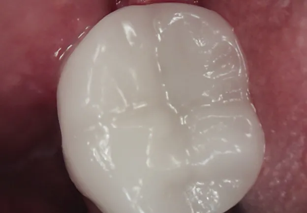 Restored tooth after same-day dental crown treatment