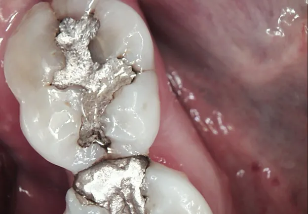 Damaged tooth before same-day crown treatment